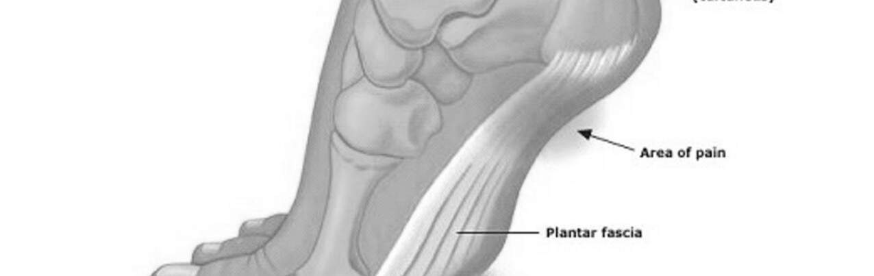 Plantar Fasciitis: Fix Your Feet!
