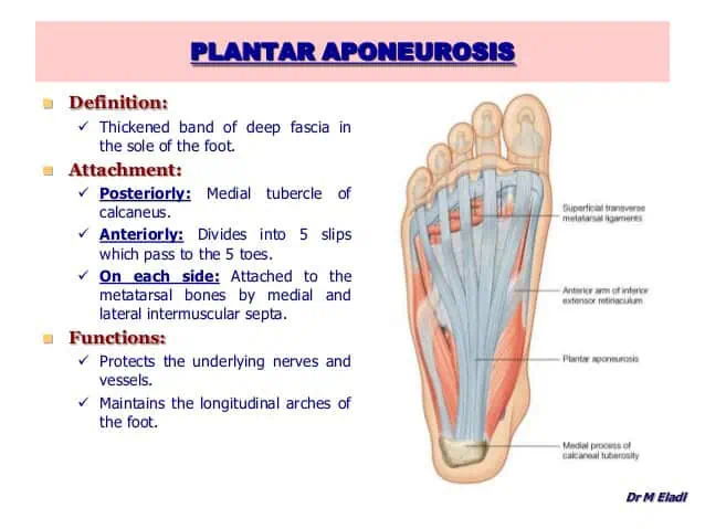 Plantar Fasciitis Diagram